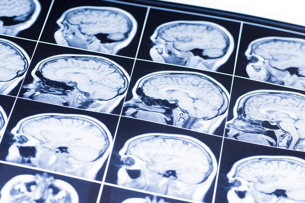 traumatic brain injury after an accident